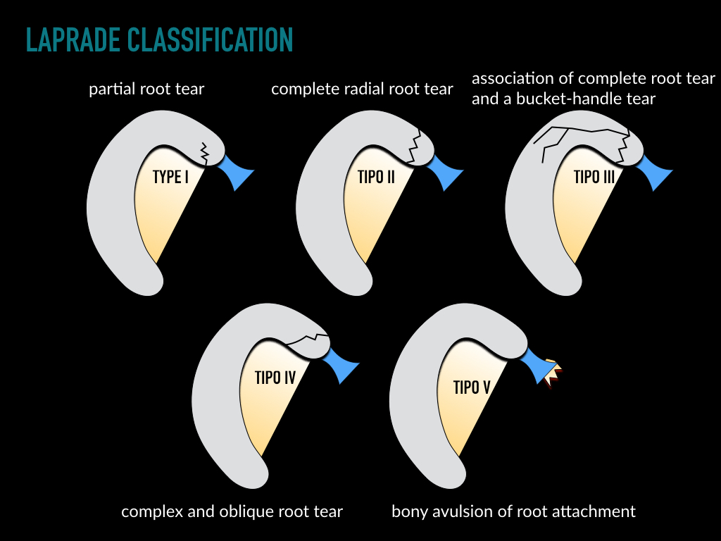 Figure 5 for case stress fracture ( RID4695 ) Osteonecrosis Meniscal Root tear